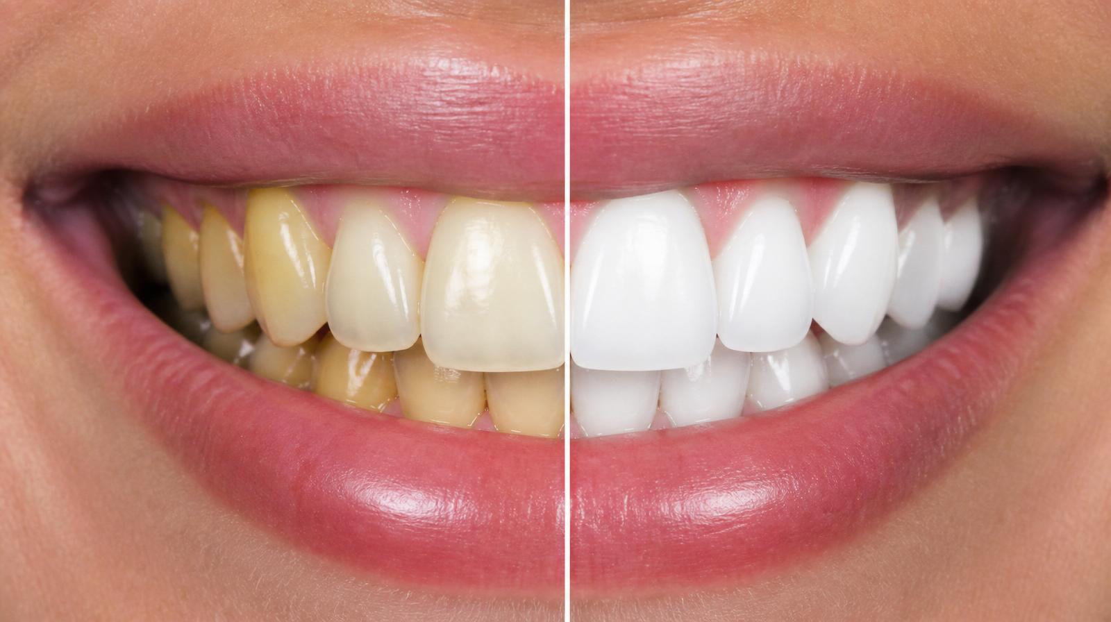 Hollywood Smile öncesi ve sonrası